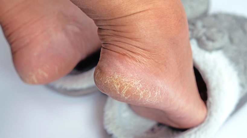 Dry Skin Issues