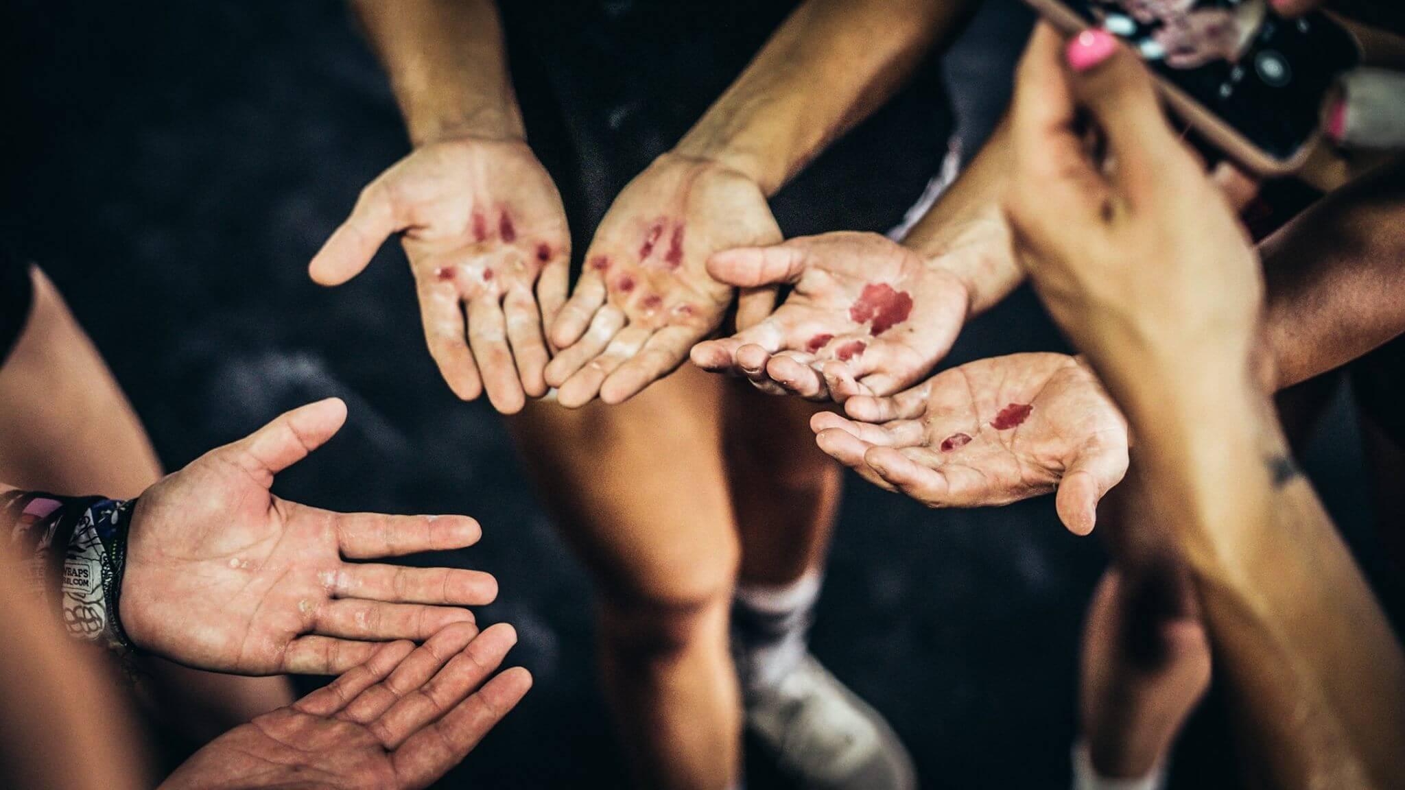 Hand Rip Treatment Hand Rips Guide: How To Treat a Ripped Callus for CrossFit – SSTUFF ...