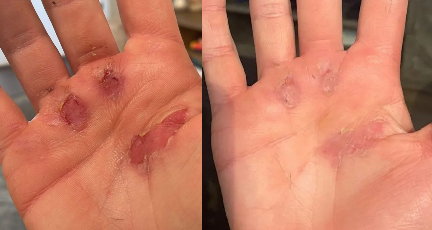 sstuff natural fast healing ripped hands from crossfit