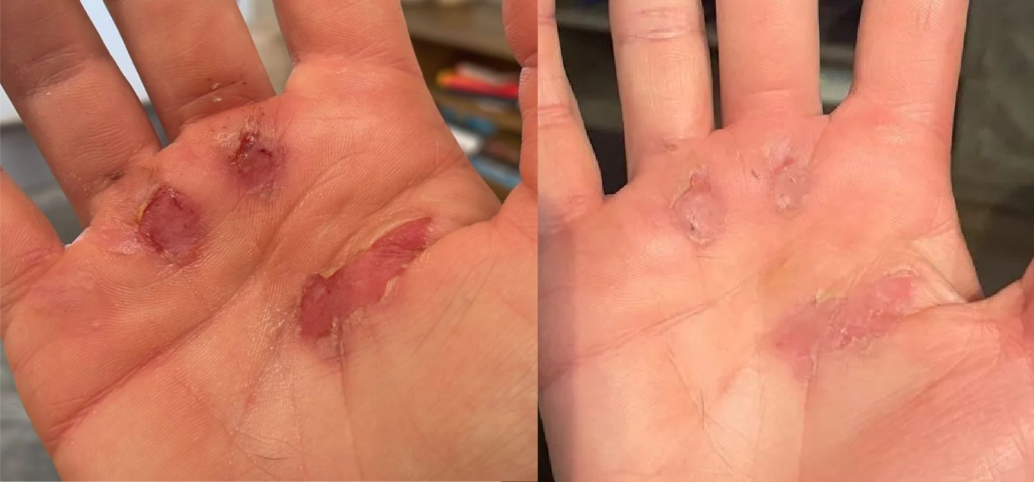 sstuff natural fast healing ripped hands from crossfit